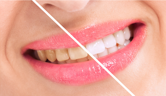 How To Whiten Teeth In Photoshop?